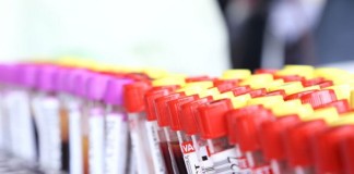 Prueba de sangre detecta biomarcadores en cáncer de páncreas