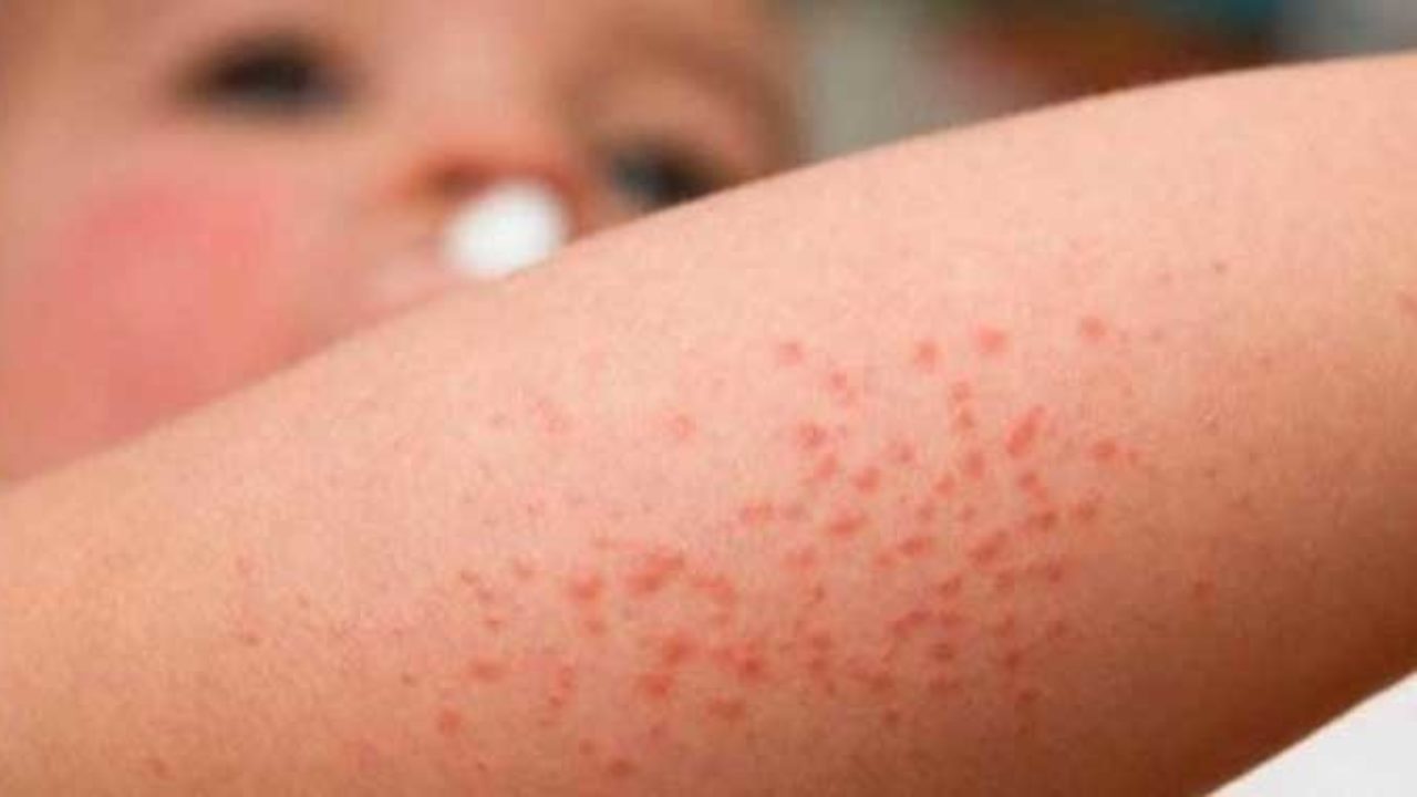 Biomarcadores De La Dermatitis Atópica Pueden Predecir El Tdah En Niños